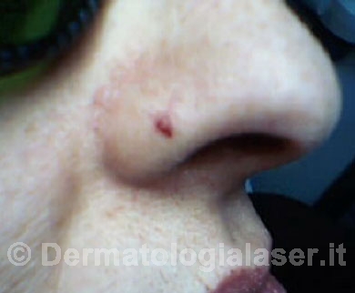 Agiomi rubuni prima dell'intervento - Dermatologia Salerno - Dott. Ligrone