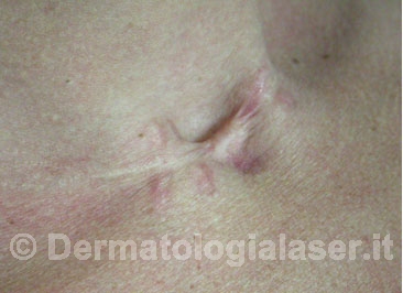Cheloidi Dopo dell'intervento - Dermatologia Salerno - Dott. Ligrone