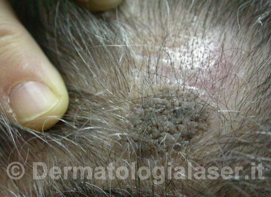 Cheratosi prima dell'intervento - Dermatologia Salerno - Dott. ligrone