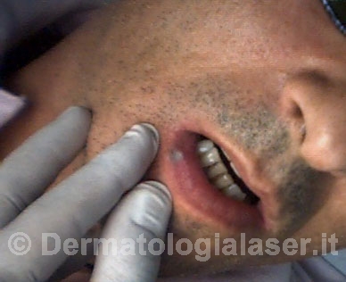 Lago venoso Dopo dell'intervento - Dermatologia Salerno - Dott. Ligrone
