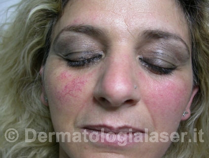 Teleangectasie prima dell'intervento - Dermatologia Salerno - Dott. Ligrone