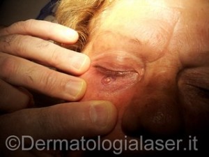 Epitelioma basocellulare cistico