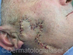 Epitelioma spinocellulare infiltrante dopo intervento