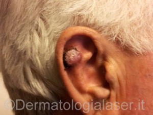Epitelioma spninocellulare