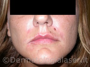 Filler Detrmatologia