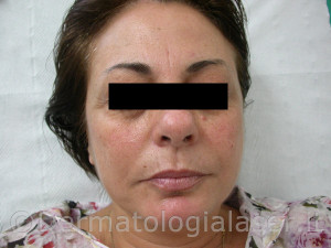 Filler Detrmatologia