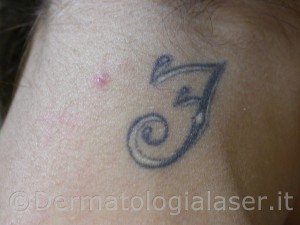 Rimozione Tatuaggi con LASER Q-Switch