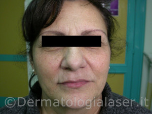 Filler Detrmatologia