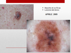 nevo melanoma