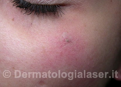 Agiomi stellari dopo dell'intervento - Dermatologia Salerno - Dott. Ligrone