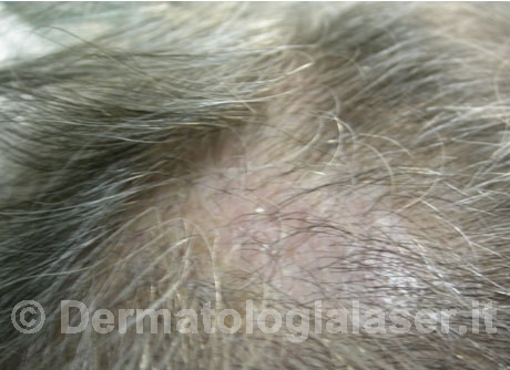 Cheratosi dopo dell'intervento - Dermatologia Salerno - Dott. ligrone
