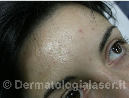 Cicatrici da acne prima dell’intervento – Dermatologia Salerno – Dott. Ligrone 