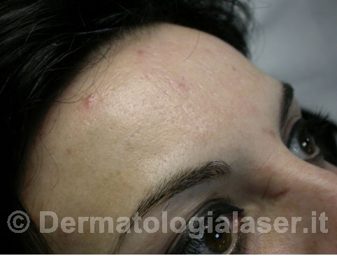 Cicatrici da acne dopo dell’intervento – Dermatologia Salerno – Dott. Ligrone