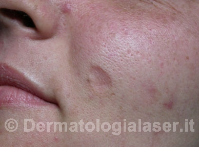 Cicatrici depresse prima dell'intervento - Dermatologia Salerno - Dott. Ligrone