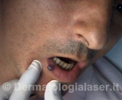 Lago venoso prima dell'intervento - Dermatologia Salerno - Dott. Ligrone