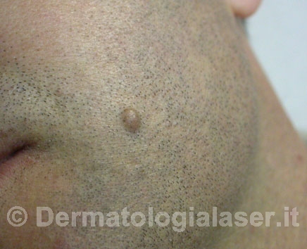 Nevo dermico prima dell'intervento - Dermatologia Salerno - Dott. Ligrone