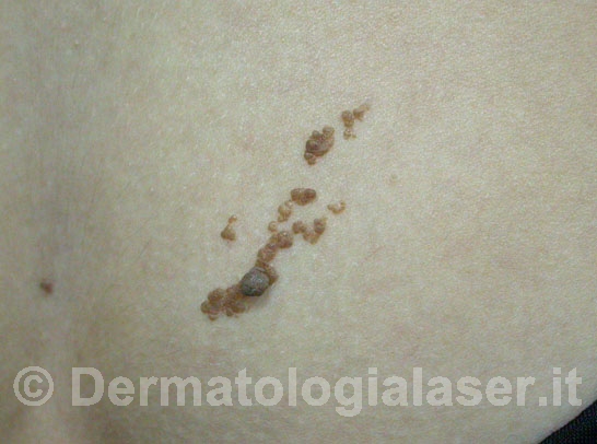 Nevo epidermico - Prima dell'intervento - Dermatologia Salerno - Dott. Ligrone