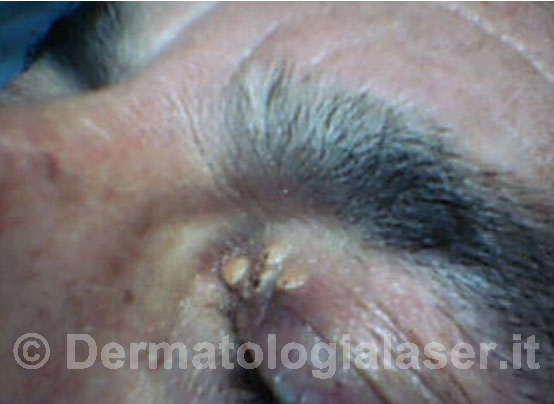 Xantelasmi Secondo caso - Prima dell'intervento - Dermatologia Salerno - Dott. Ligrone