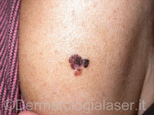 Melanoma