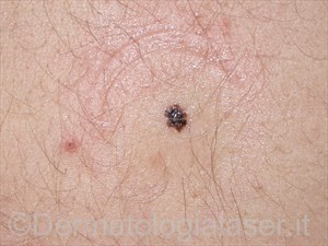 Melanoma a diffusione superficiale