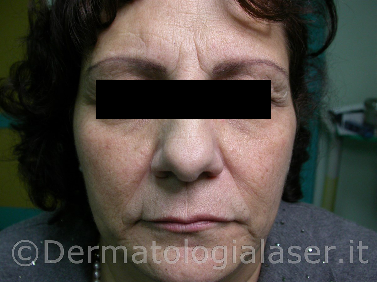 Filler Dermatologia